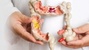 Probiotics for IBS